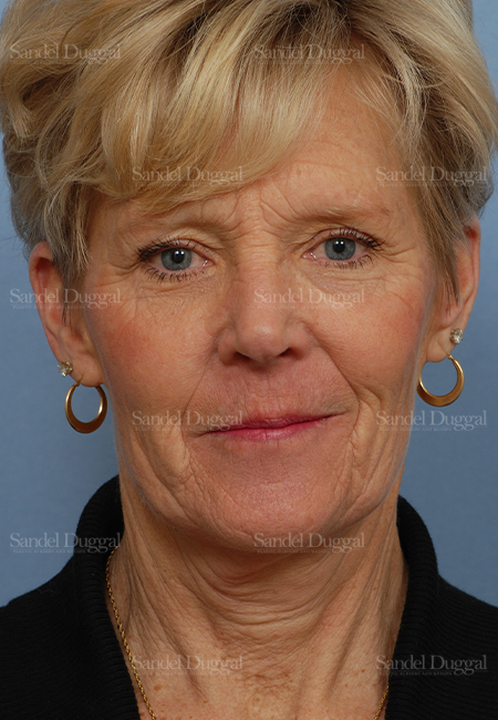 facelift patient