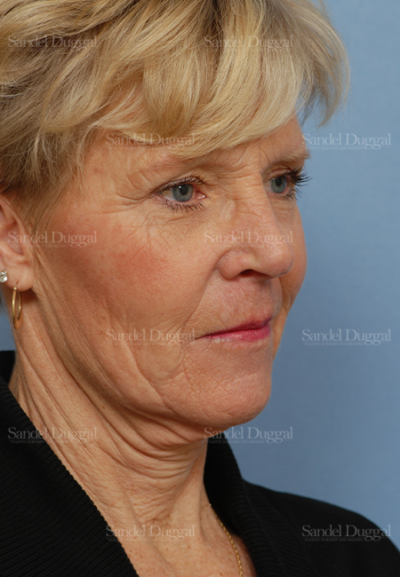 facelift patient