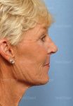 facelift patient