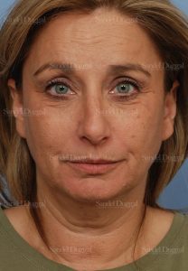 facelift patient