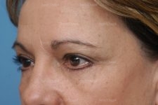forehead lift patient