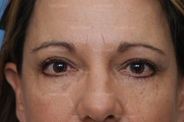 forehead lift patient