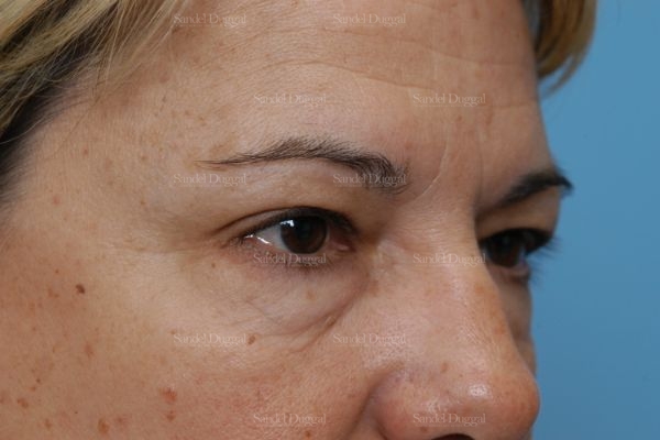 forehead lift patient