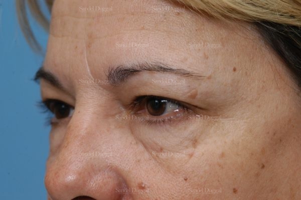 forehead lift patient
