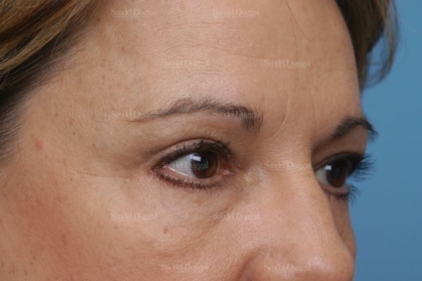 forehead lift patient