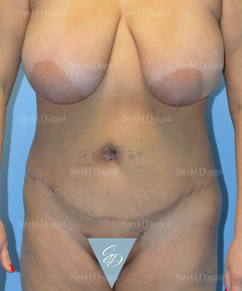 liposuction patient