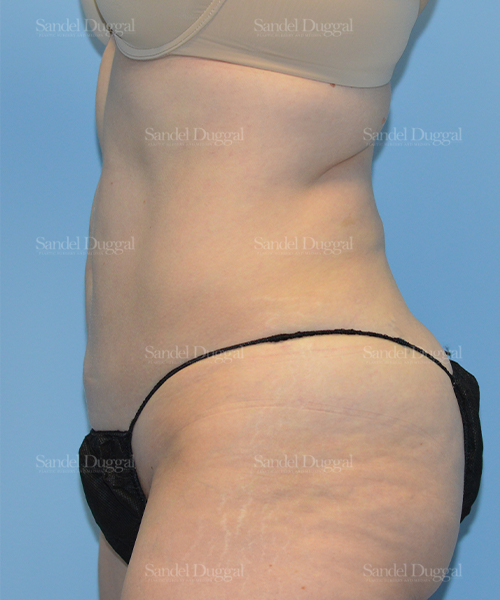 liposuction patient