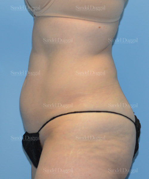 liposuction patient