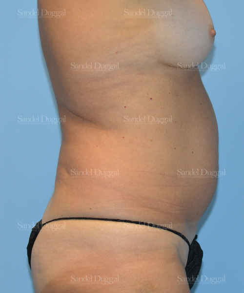 before liposuction patient case 2451
