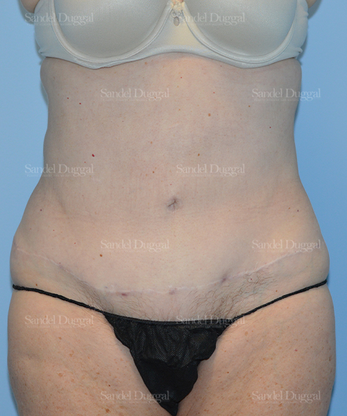 after liposuction patient case 2464