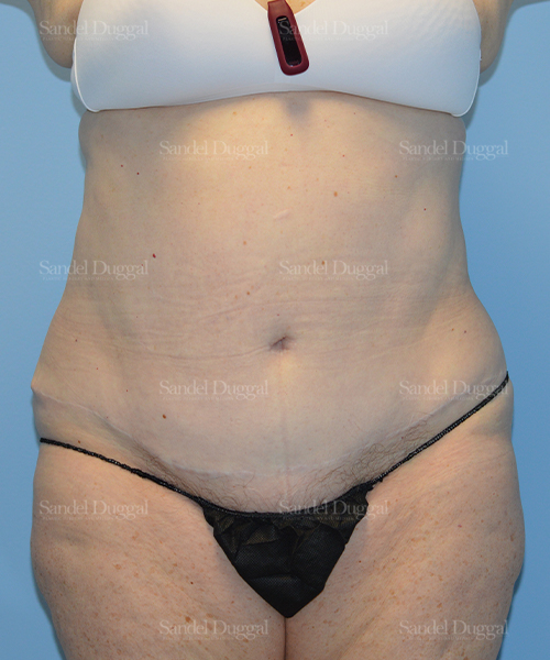 before liposuction patient case 2464