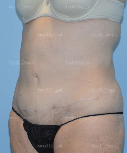 after liposuction patient case 2464