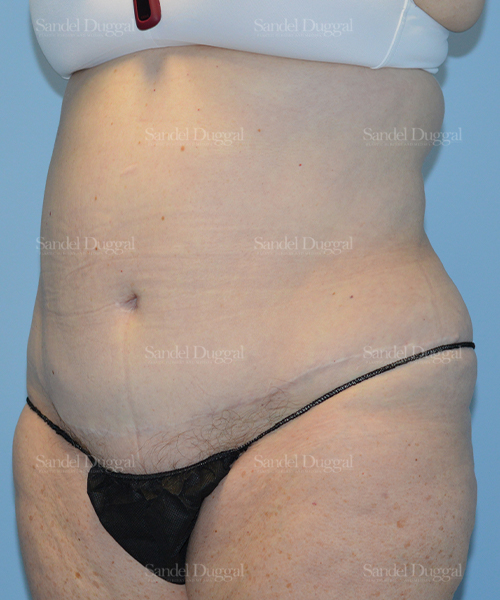 before liposuction patient case 2464
