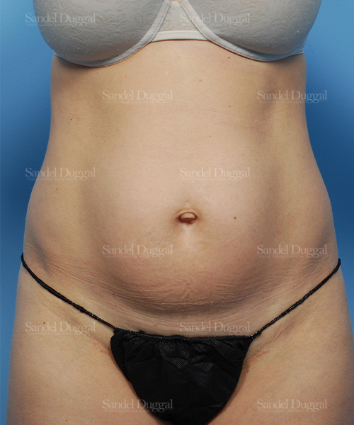 before liposuction patient case 2474