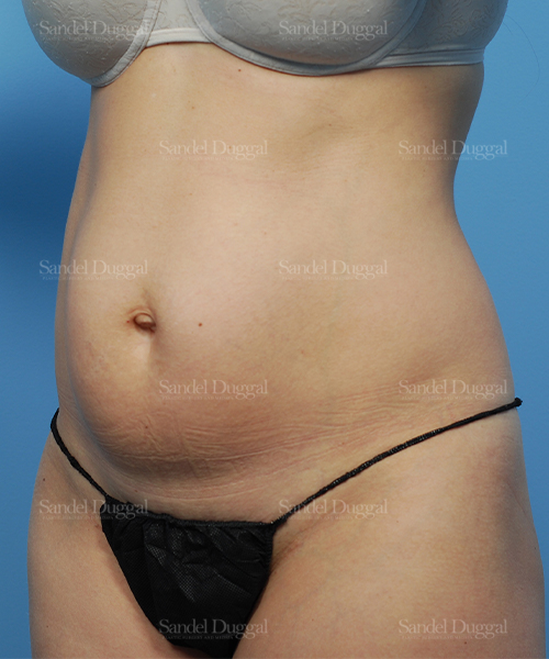 before liposuction patient case 2474