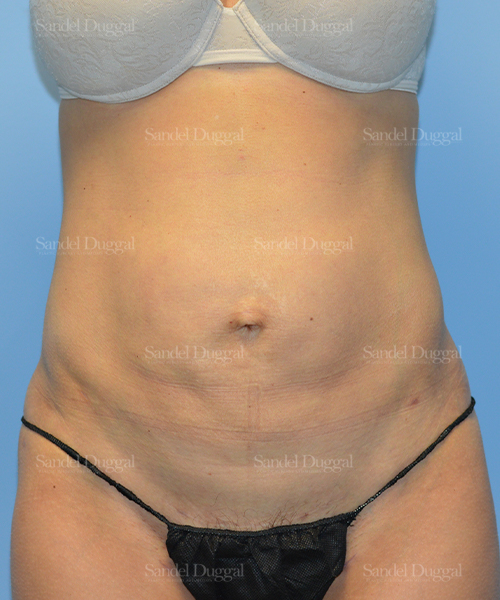 after liposuction patient case 2474