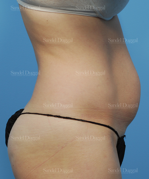 before liposuction patient case 2479
