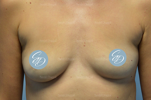 bra roll liposuction patient