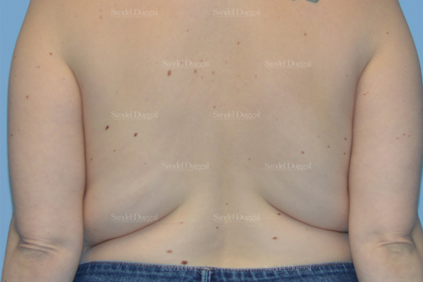 leg and flank liposuction patient
