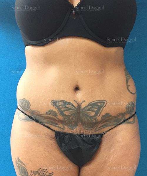leg and flank liposuction patient