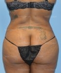leg and flank liposuction patient