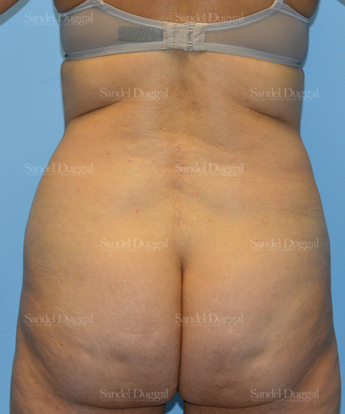 leg and flank liposuction patient