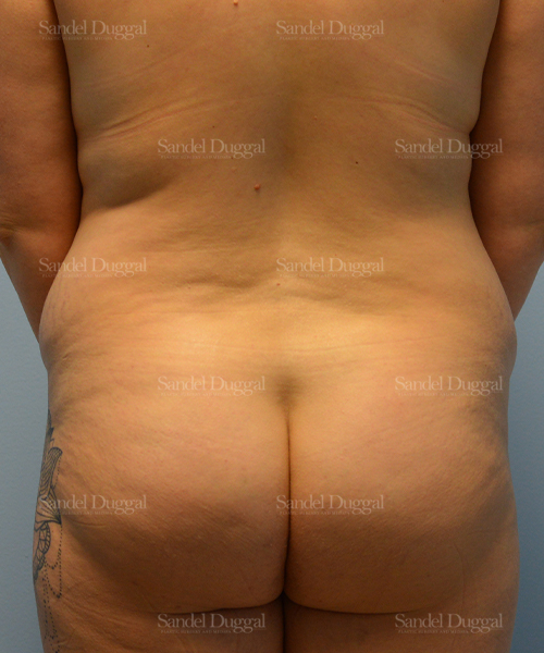 leg and flank liposuction patient