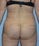 leg and flank liposuction patient