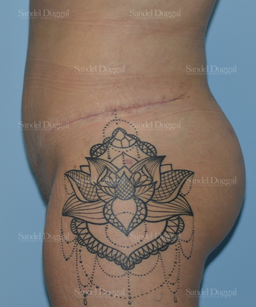 leg and flank liposuction patient