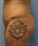 leg and flank liposuction patient