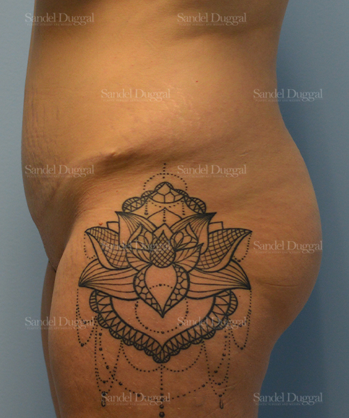 leg and flank liposuction patient