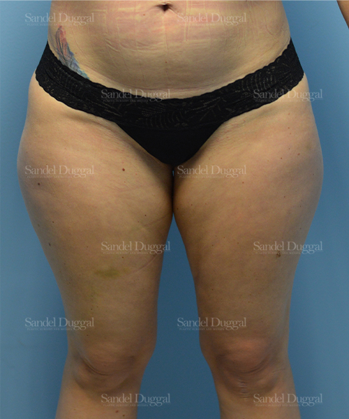 leg and flank liposuction patient