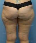 leg and flank liposuction patient