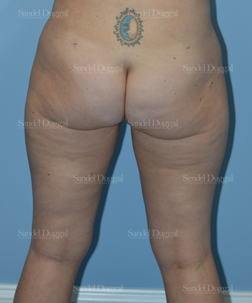 leg and flank liposuction patient