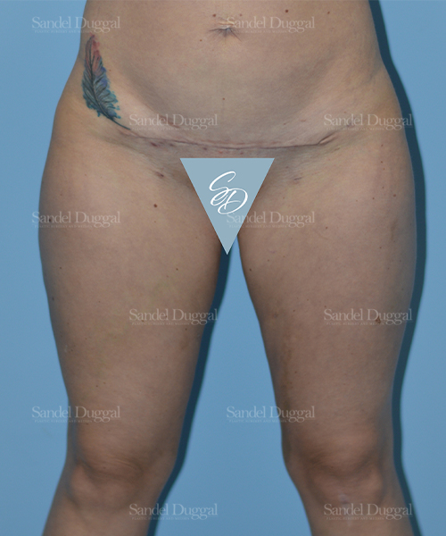 leg and flank liposuction patient