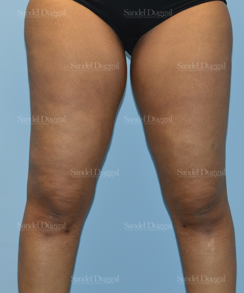 leg and flank liposuction patient