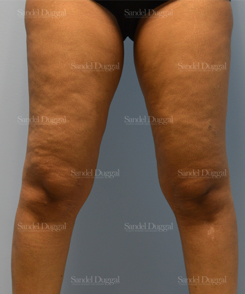 leg and flank liposuction patient