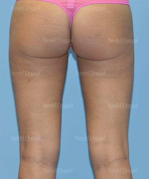 leg and flank liposuction patient