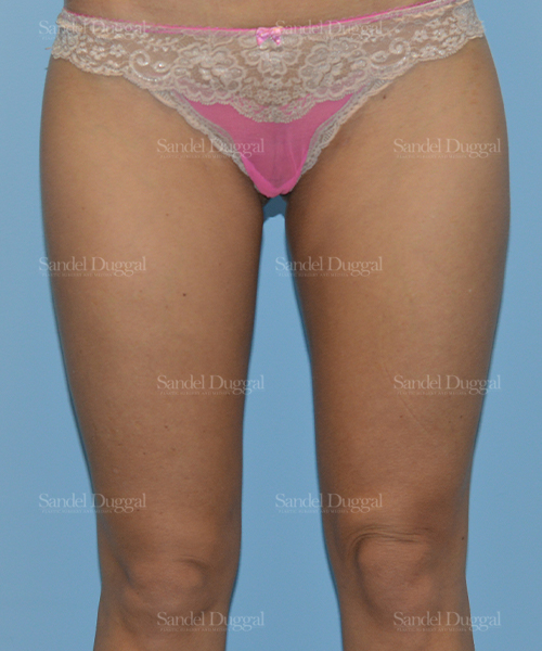 leg and flank liposuction patient