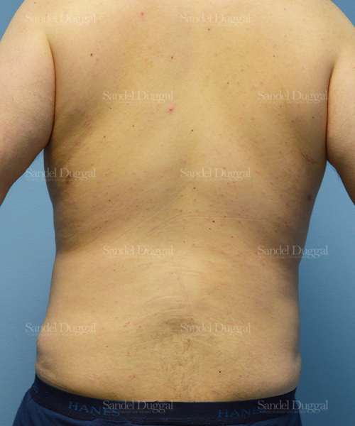 leg and flank liposuction patient