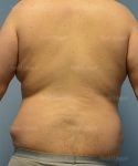 leg and flank liposuction patient