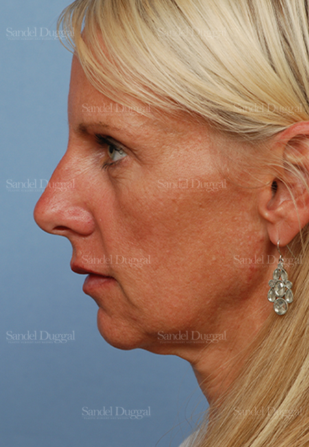 mini facelift patient