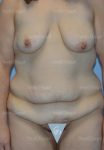 mommy makeover patient