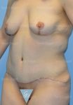 mommy makeover patient
