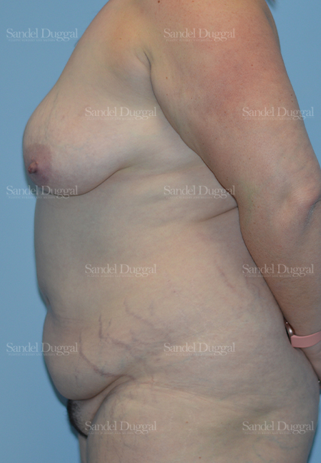 mommy makeover patient