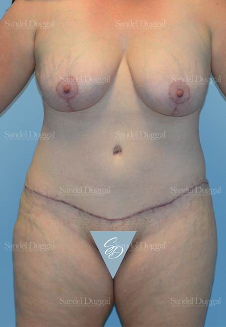 mommy makeover patient