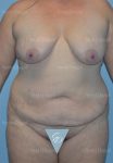 mommy makeover patient