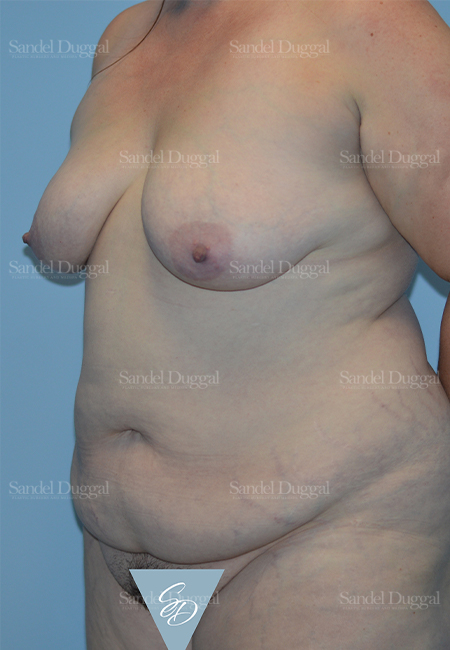 mommy makeover patient