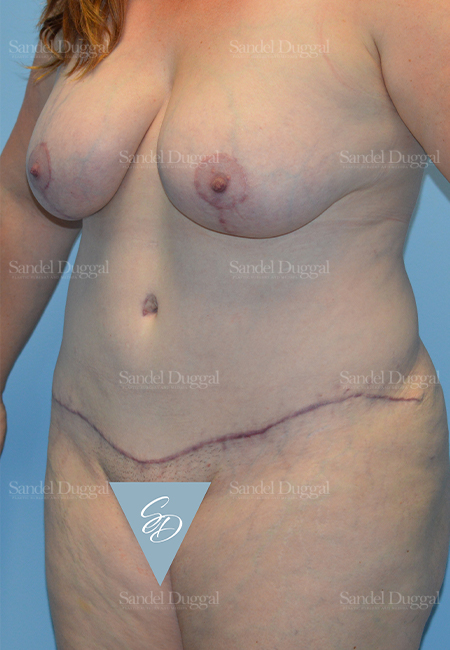 mommy makeover patient