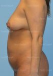 mommy makeover patient